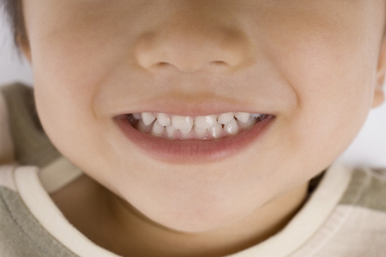 乳歯や生え始めた永久歯はむし歯になりやすい